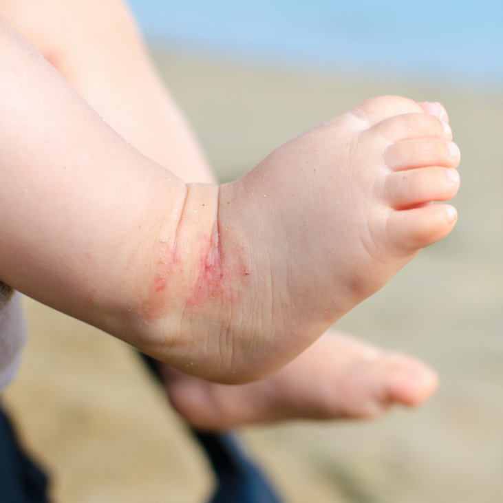 infant eczema how to treat